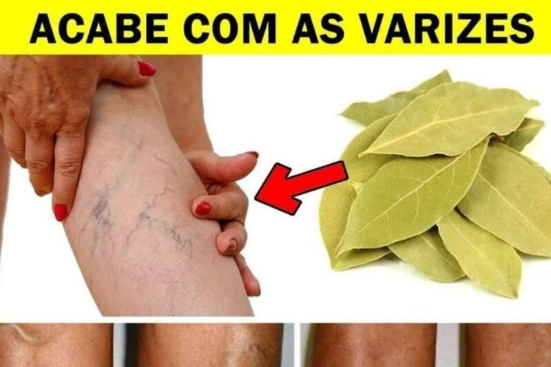 Acabe com as Varizes com esse Remédio Caseiro com Folha de Louro